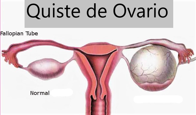 Quistes De Ovario Tu Gine Al Día 4791